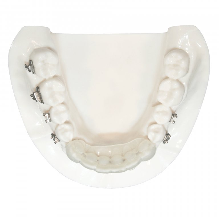 Retainers Five Star Orthodontic