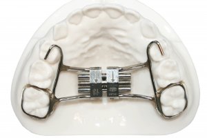 Expanders - Five Star Orthodontic