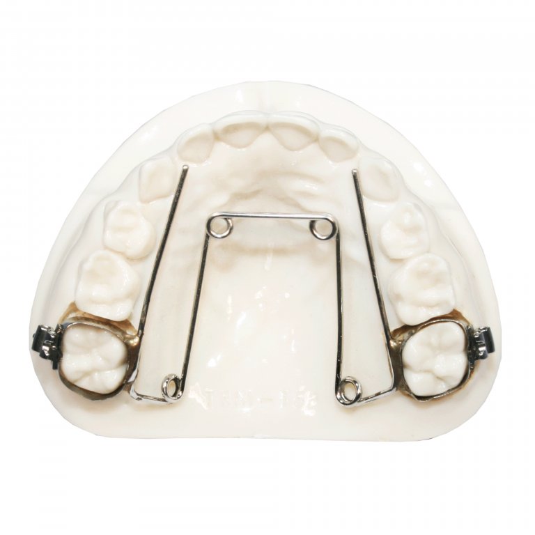 Quad-helix - Five Star Orthodontic