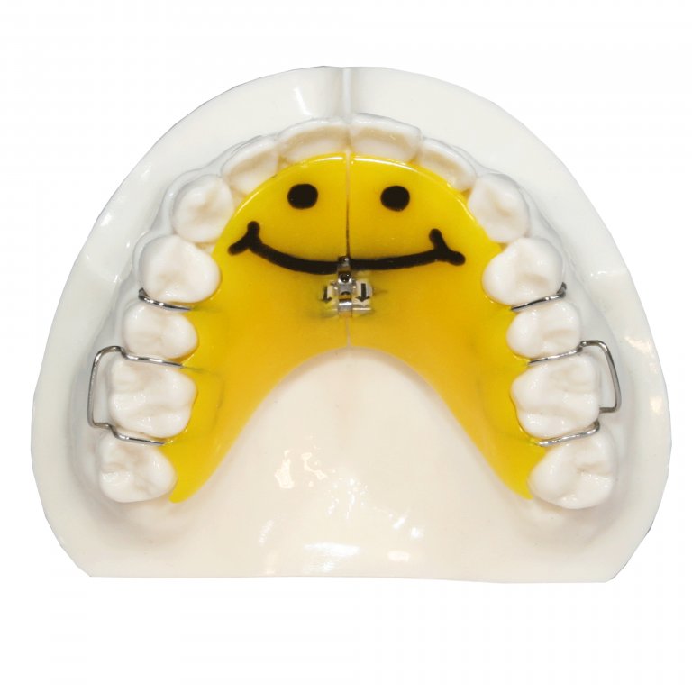 Expanders Five Star Orthodontic