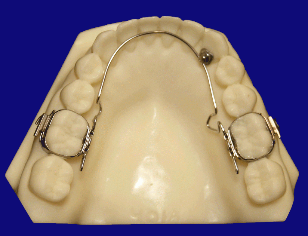 Wilson-Mandibular