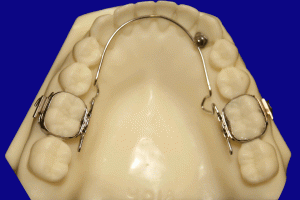 Wilson-Mandibular