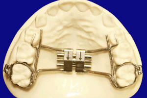 rpe-mixed-dentition