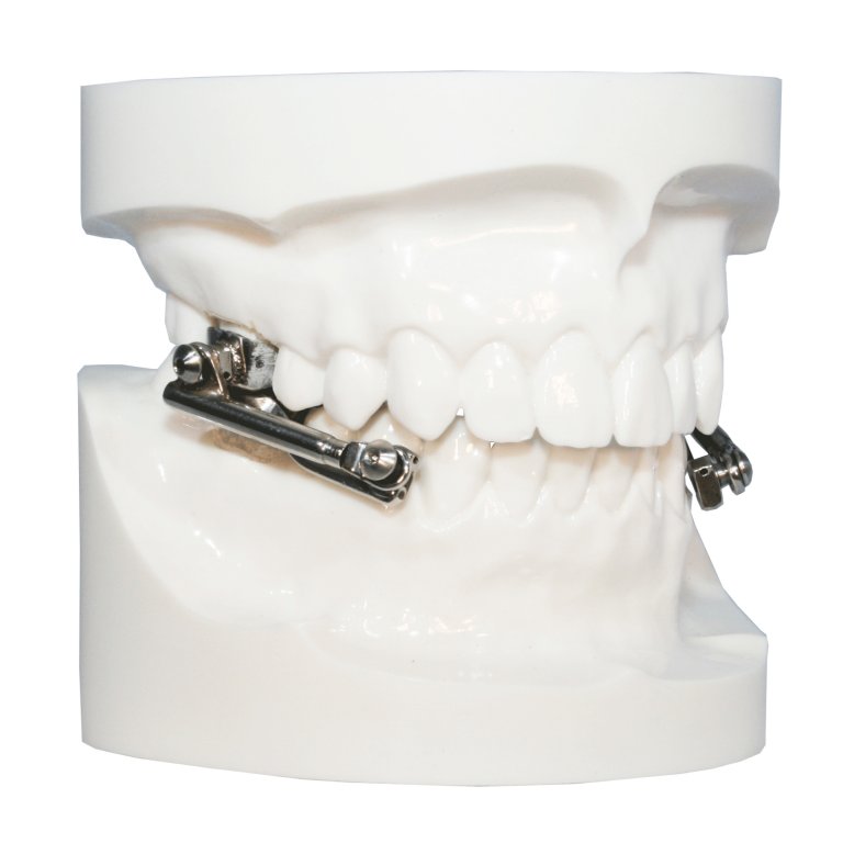 Class II Appliances Five Star Orthodontic