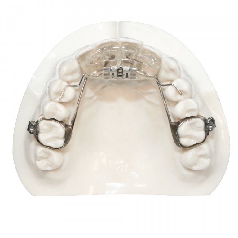 Class II Appliances | Five Star Orthodontic