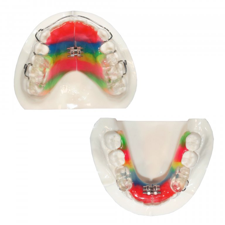 TwinBlock Five Star Orthodontic