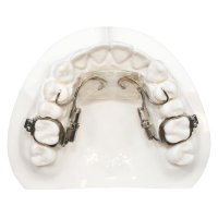 Distalizers | Five Star Orthodontic