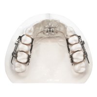 Distalizers | Five Star Orthodontic